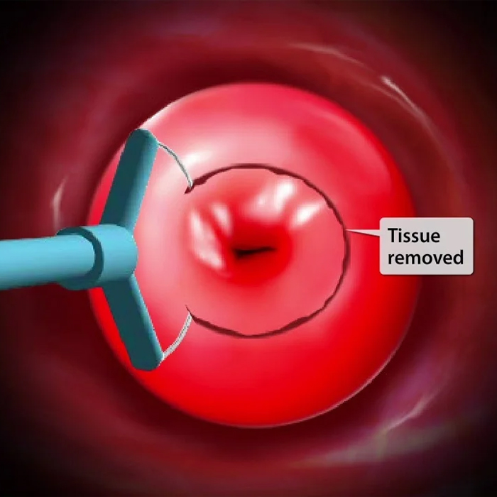 Loop Electrosurgical Excision Procedure (LEEP)