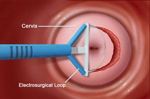 Transvaginal Oocyte Retrieval in Punjab