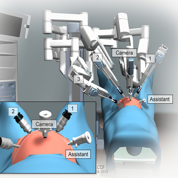 Robotic-Assisted Sacrocolpopexy