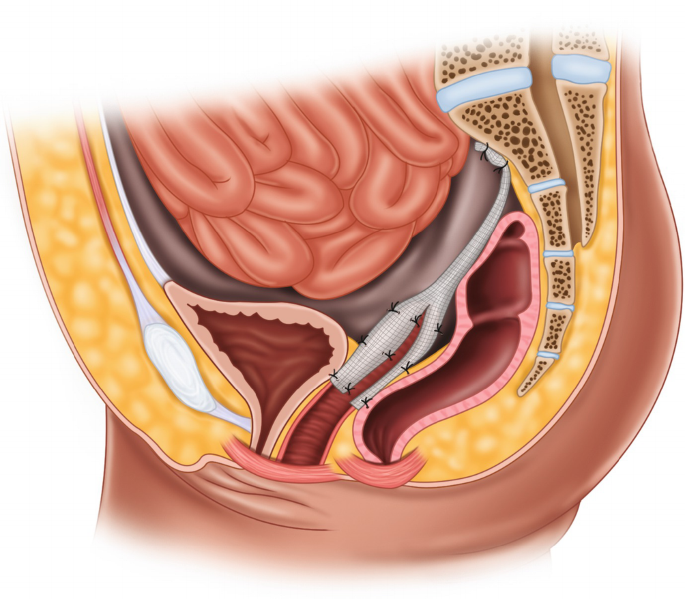 Surgeon for Transvaginal Oocyte Retrieval in Jalandhar