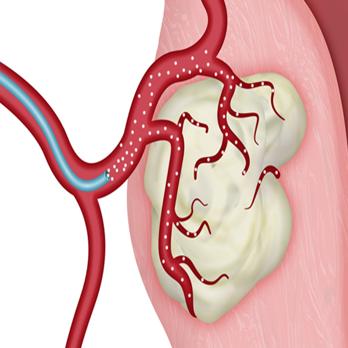 Uterine Fibroid Embolization (UFE)