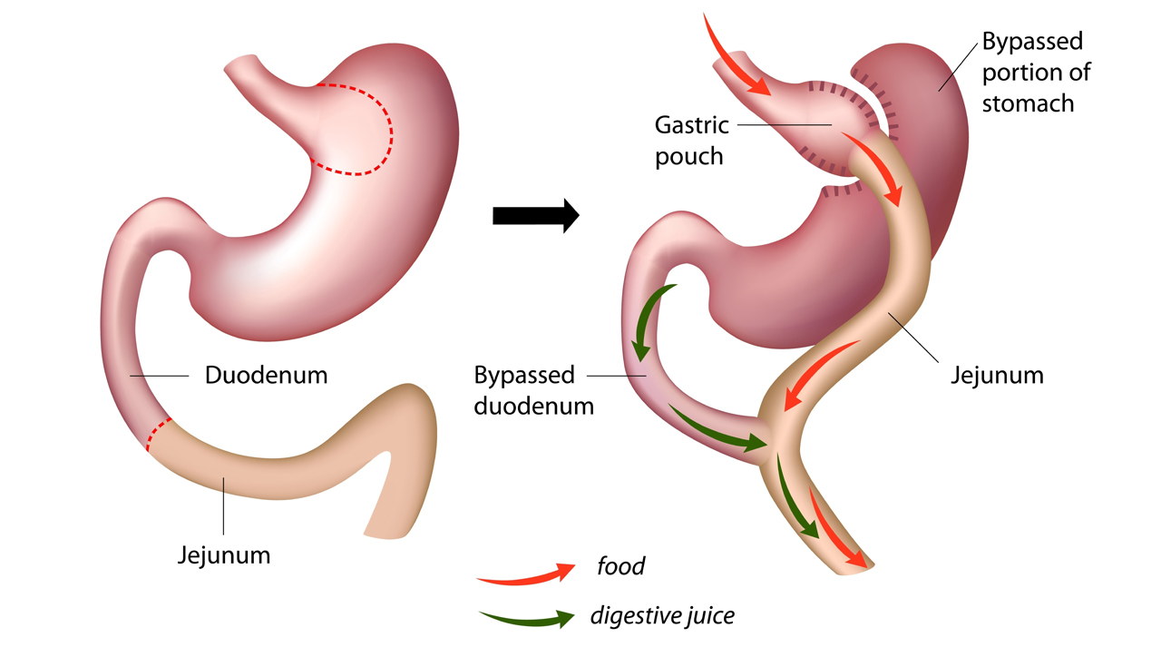 Roux-En-Y Gastric Bypass