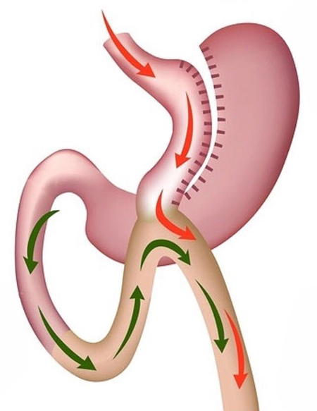 Mini Gastric Bypass