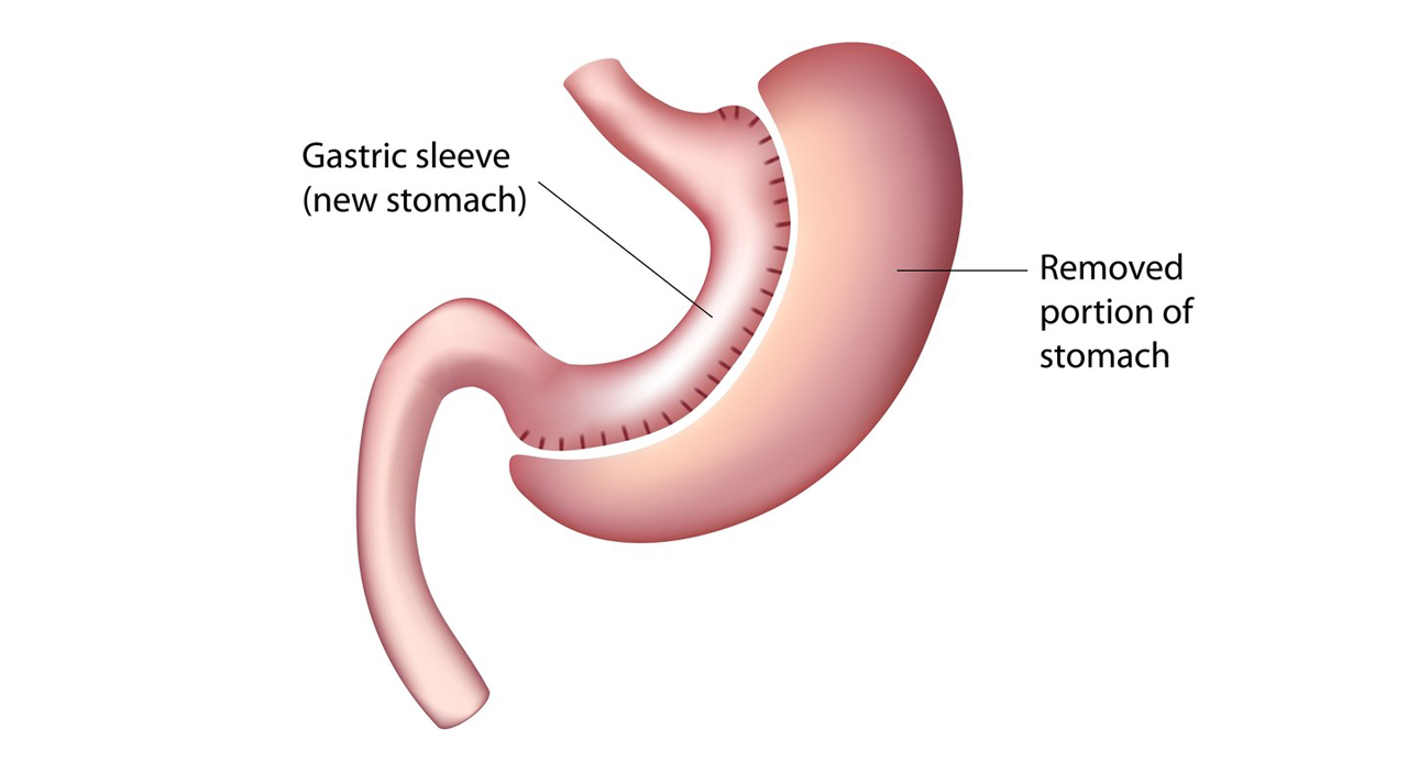 Sleeve Gastrectomy